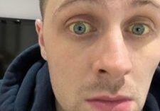 Tom Liver Transplant Jaundice
