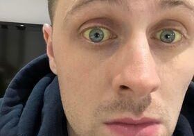 Tom Liver Transplant Jaundice