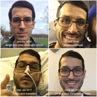 Transplant tips