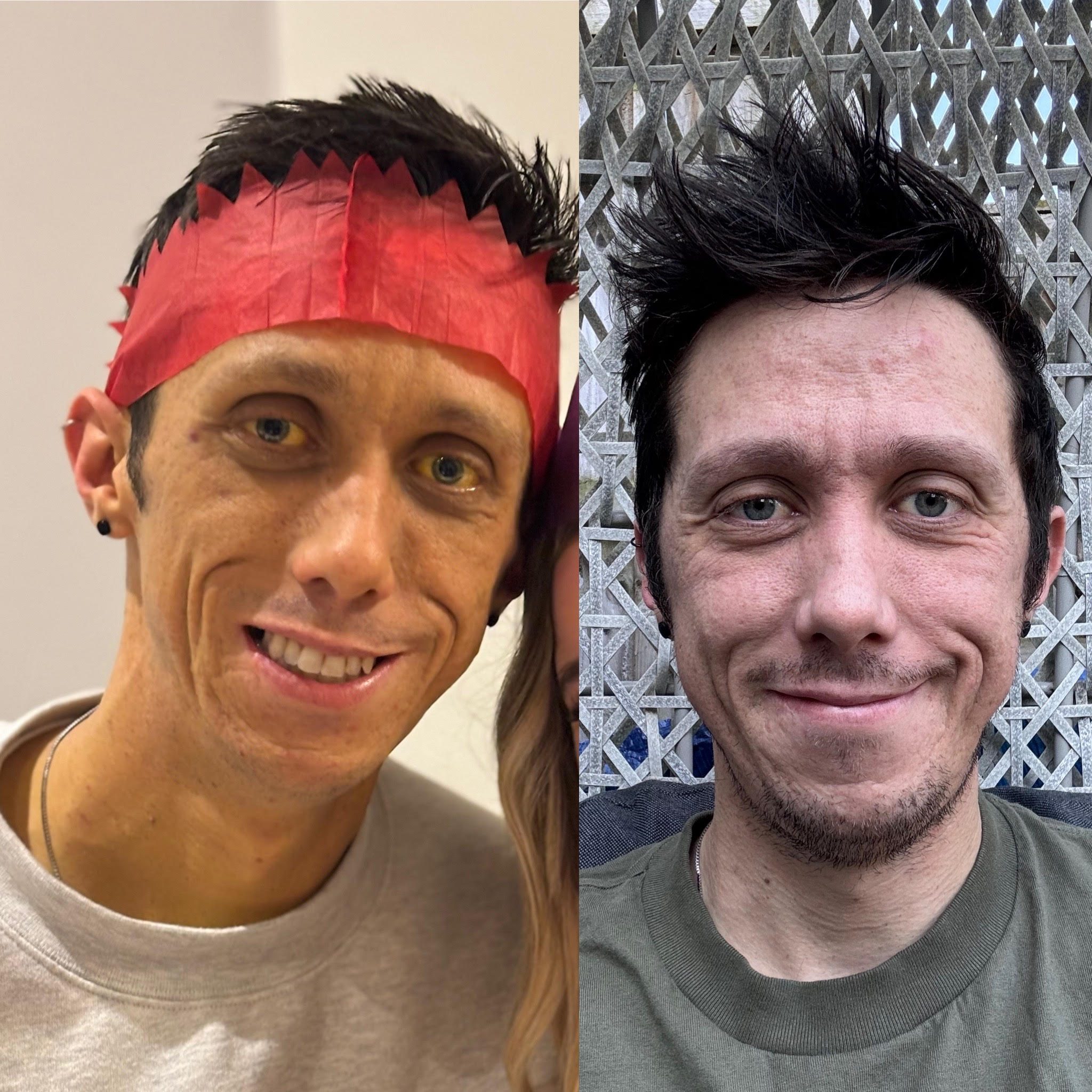 imgBJ20240871v2 Before and after picture of Ben. Left Ben looking at camera smiling, red Christmas hat on, jaundiced skin. Right Ben looking at camera smiling looking healthy and happy