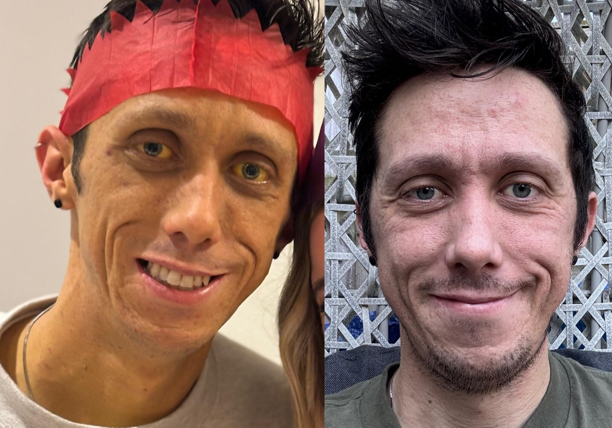 Before and after picture of Ben. Left Ben looking at camera smiling, red Christmas hat on, jaundiced skin. Right Ben looking at camera smiling looking healthy and happy