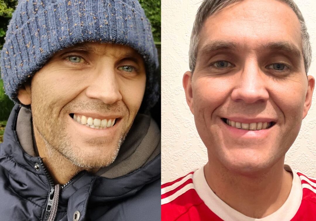 Left: Daniel before transplant looking gaunt and yellow. Right: Daniel just 10 days after surgery, already feeling great and filling out in the face.