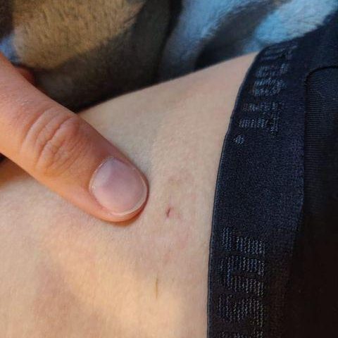 imgKH2 Katie - biopsy scar